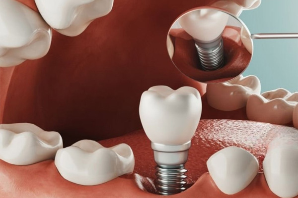 Pavienių dantų implantacija