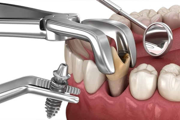 Dantų momentinė implantacija