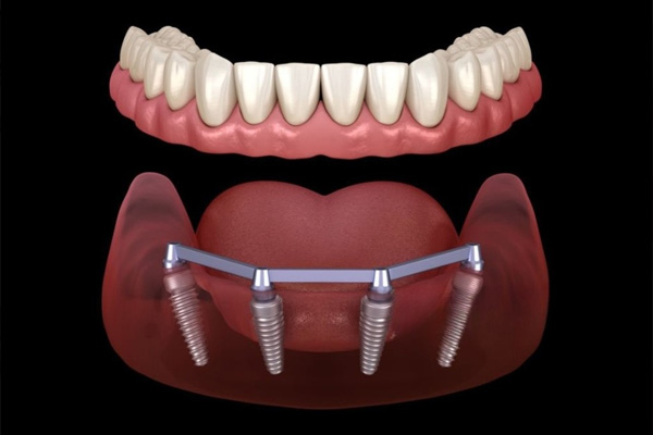 Dantų implantacija - „Visi ant keturių” (All-on-4) metodas