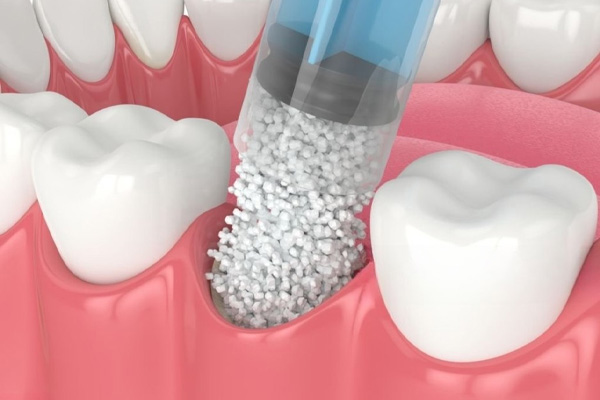 Kaulo priauginimas su implantacija