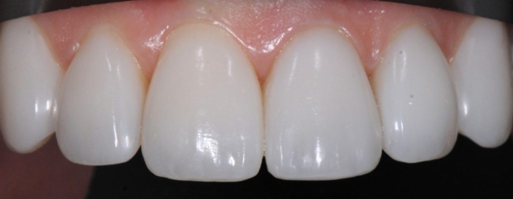 Gydytojos odontologės, estetinių restauracijų specialistės, Ingos Linkytės-Šližienės atvejis po