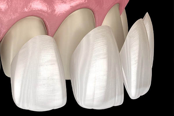 Dantų laminatės - porceliano laminatės
