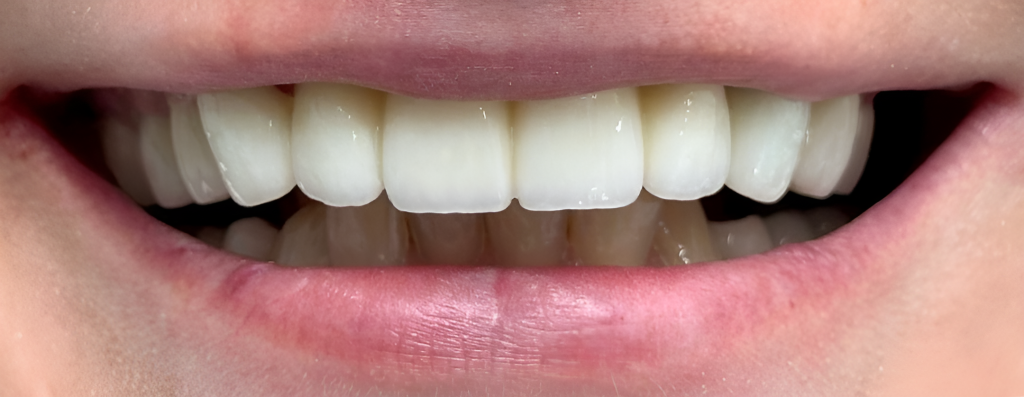 Gydytojo odontologo Justino Bardijevskio „All-on-4” gydymo atvejis po