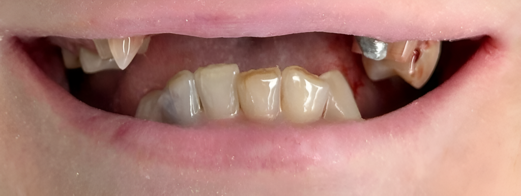 Gydytojo odontologo Justino Bardijevskio „All-on-4” gydymo atvejis prieš