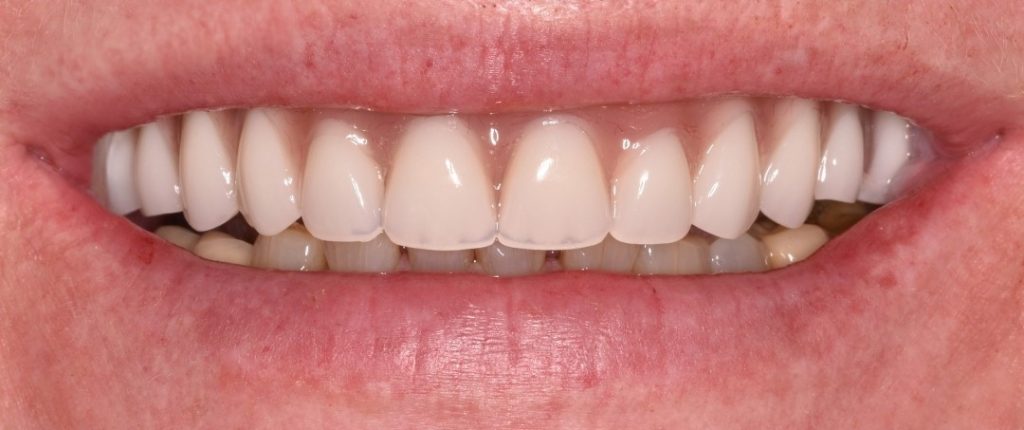 Gydytojo odontologo Justino Bardijevskio „All-on-4” gydymo atvejis po