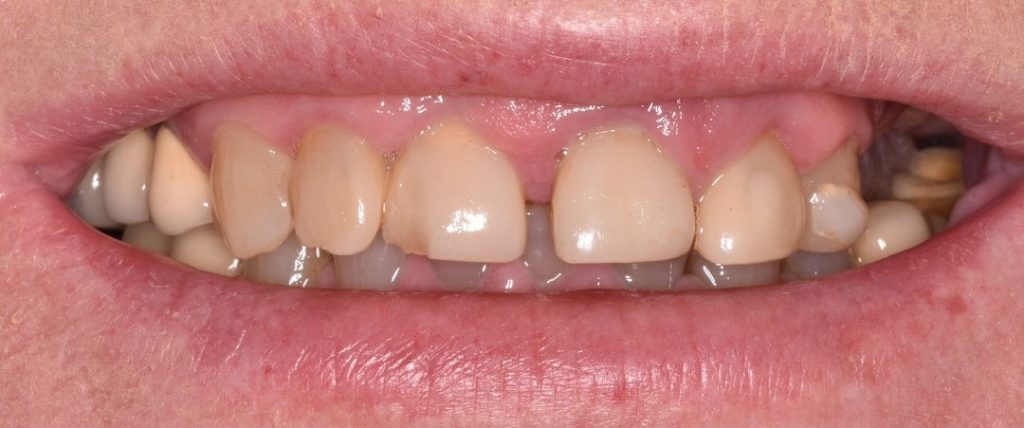 Gydytojo odontologo Justino Bardijevskio „All-on-4” gydymo atvejis prieš