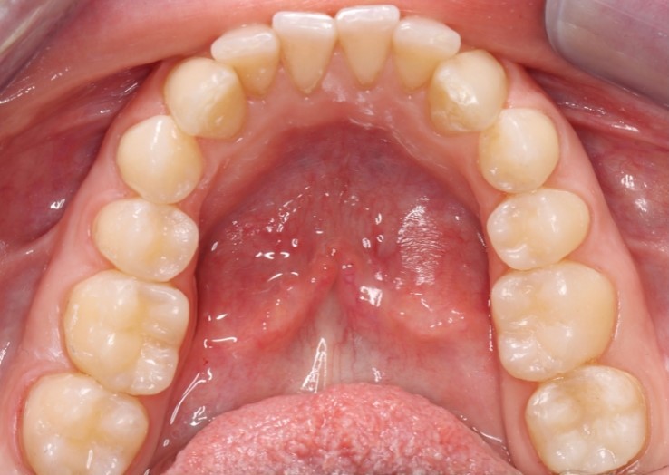 Gydytojos odontologės Viltės Gabalytės sąkandžio aukščio atstatymo atvejis po