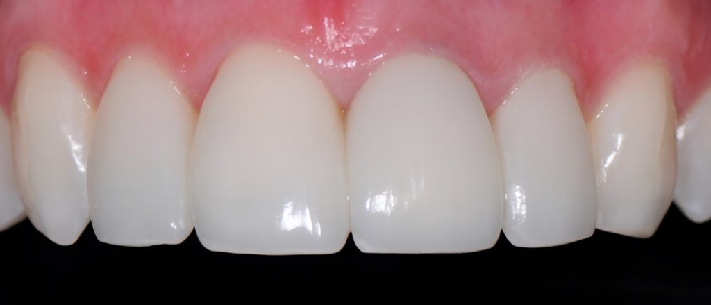 Gydytojo odontologo, estetinių restauracijų specialisto, Žilvino Budrevičiaus atvejis po