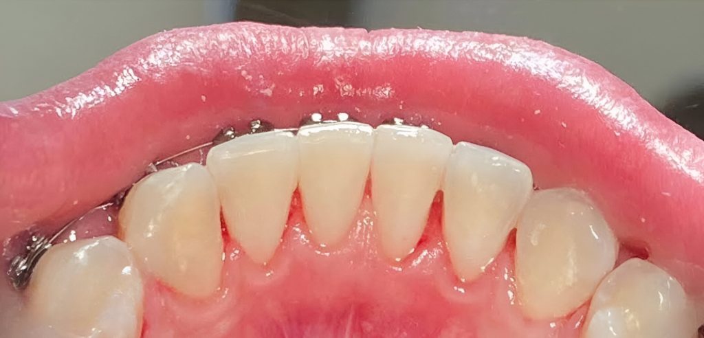 Profesionali burnos higiena su „AirFlow” metodika, burnos higienistės Justės Kunčiuvienės atvejis po