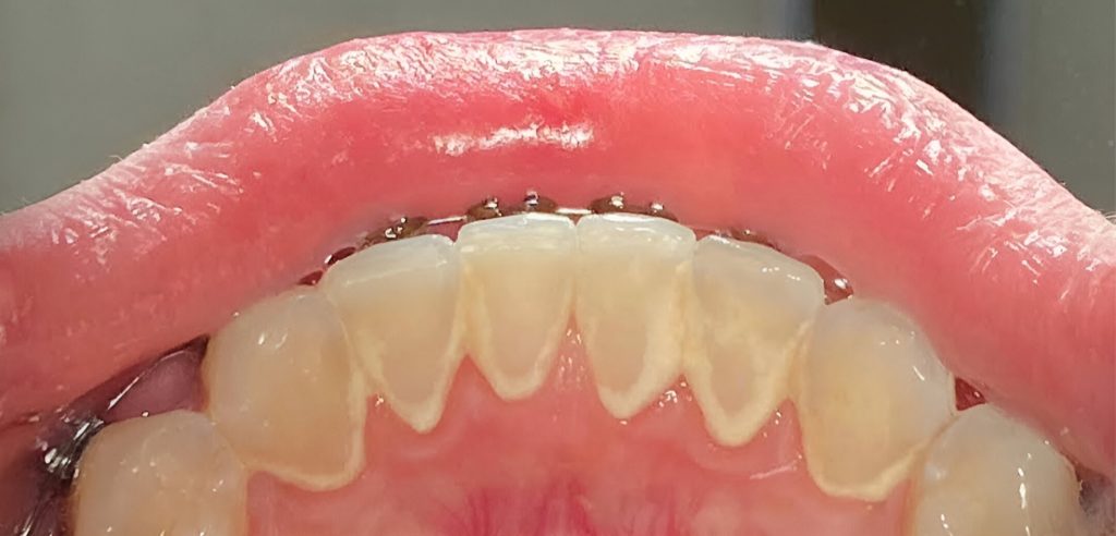 Profesionali burnos higiena su „AirFlow” metodika, burnos higienistės Justės Kunčiuvienės atvejis prieš