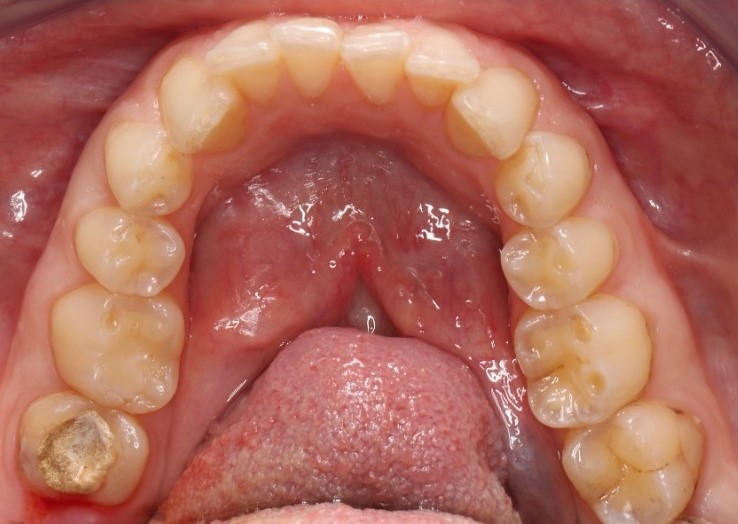 Gydytojos odontologės Viltės Gabalytės sąkandžio aukščio atstatymo atvejis prieš