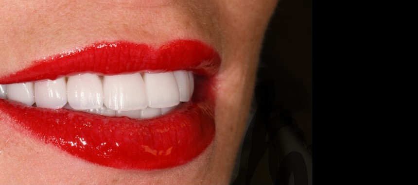 Gydytojo odontologo, estetinių restauracijų specialisto, Žilvino Budrevičiaus atvejis po