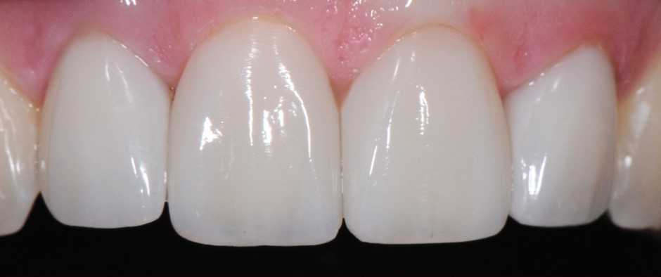 Gydytojos odontologės, estetinių restauracijų specialistės, Ingos Linkytės-Šližienės atvejis po