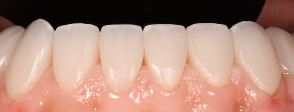 Gydytojo odontologo, estetinių restauracijų specialisto, Žilvino Budrevičiaus atvejis po