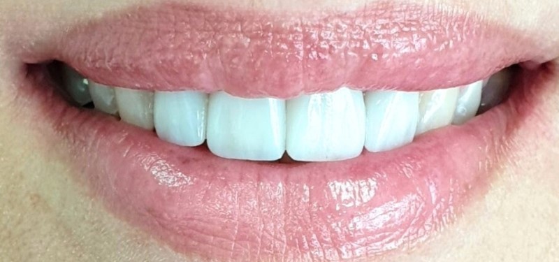 Gydytojos odontologės, estetinių restauracijų specialistės, Ingos Linkytės-Sližienės atvejis po