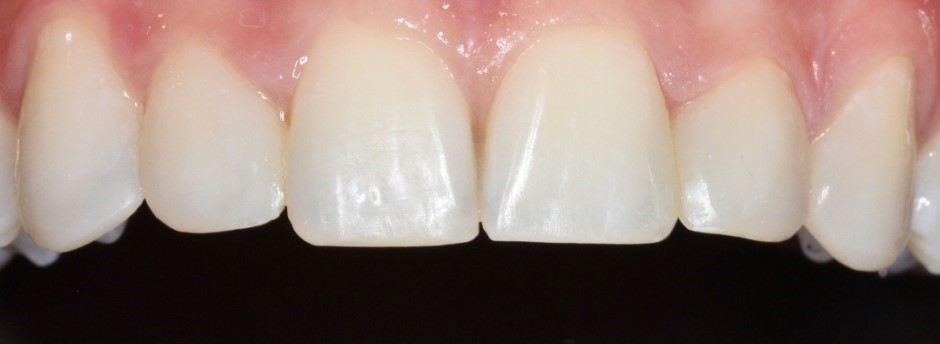 Gydytojos odontologės, estetinių restauracijų specialistės, Odetos Bardijevskienės atvejis po