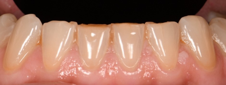 Gydytojo odontologo, estetinių restauracijų specialisto, Žilvino Budrevičiaus atvejis prieš