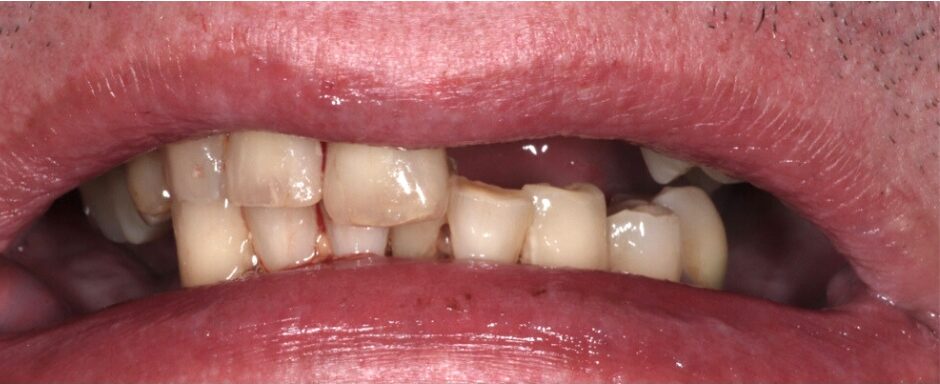 Gydytojos odontologės Viltės Gabalytės pilnos šypsenos atkūrimo atvejis prieš