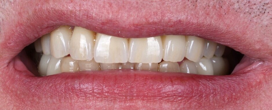 Gydytojos odontologės Viltės Gabalytės pilnos šypsenos atkūrimo atvejis po