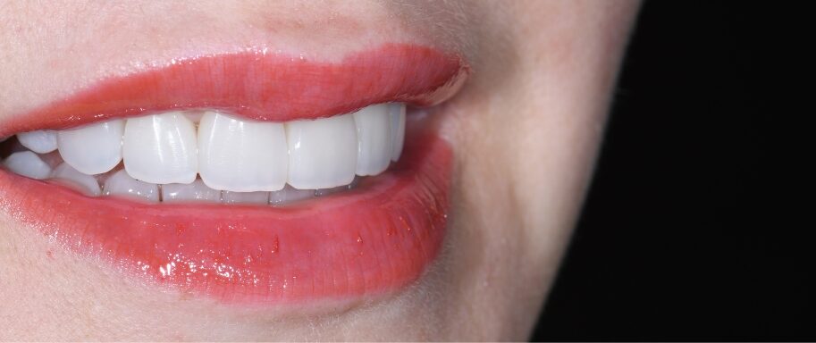 Gydytojo odontologo, estetinių restauracijų specialisto, Žilvino Budrevičiaus atvejis po