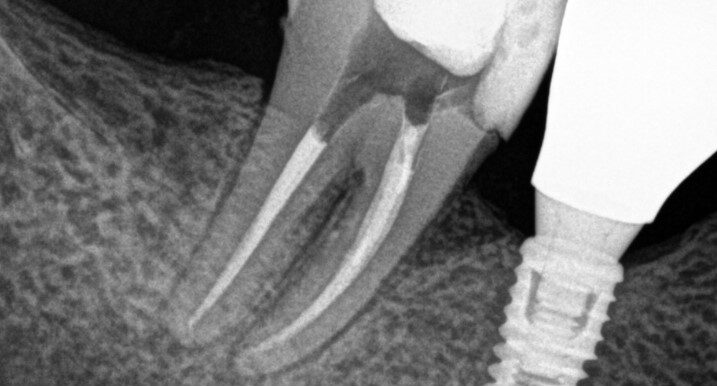Gydytojo endodontologo Pedram Hosseinzadehfard dantų šaknų kanalų gydymo atvejis po