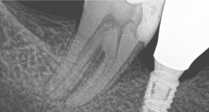 Gydytojo endodontologo Pedram Hosseinzadehfard dantų šaknų kanalų gydymo atvejis prieš