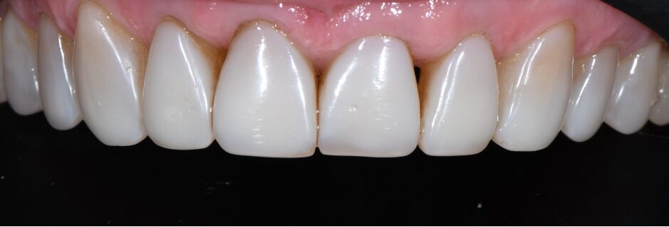 Gydytojo odontologo, estetinių restauracijų specialisto, Žilvino Budrevičiaus atvejis prieš