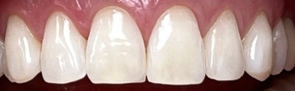 Burnos higienistės Kamilės Kazlauskaitės dantų balinimo Philips ZOOM sistema atvejis po