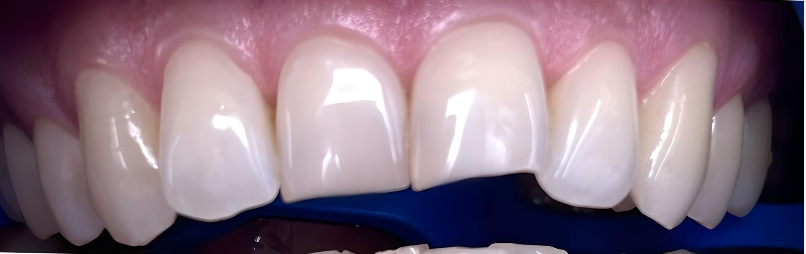 Burnos higienistės Žibuoklės Buinevičiūtės dantų balinimo Philips ZOOM sistema atvejis po