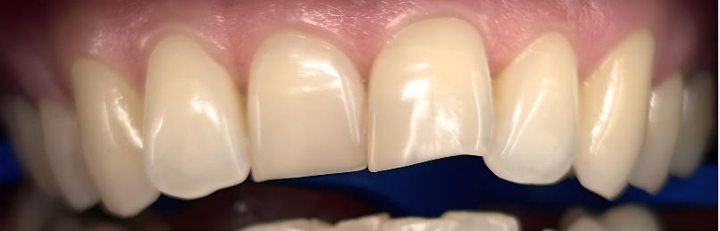 Burnos higienistės Žibuoklės Buinevičiūtės dantų balinimo Philips ZOOM sistema atvejis prieš