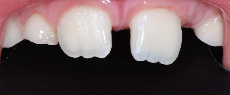 Gydytojo odontologo, estetinių restauracijų specialisto, Žilvino Budrevičiaus atvejis po