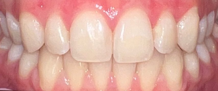 Dantų tiesinimo kapomis specialistės, gydytojos odontologės Viktorijos Šimkutės atvejis po