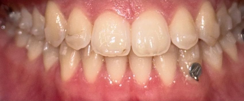 Dantų tiesinimo kapomis specialistės, gydytojos odontologės Viktorijos Šimkutės atvejis po