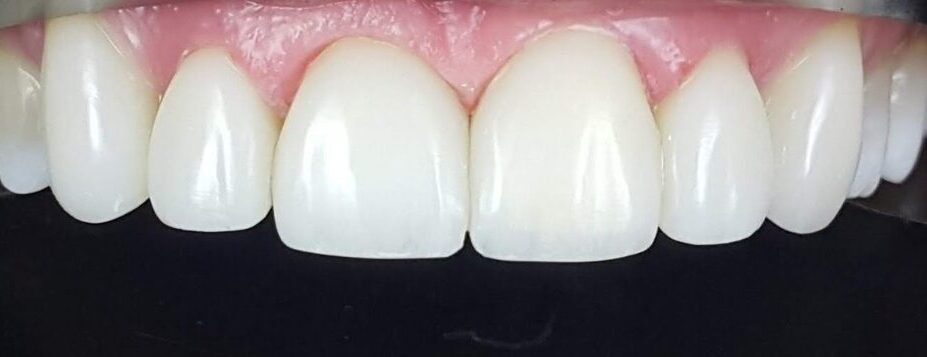 Gydytojos odontologės, estetinių restauracijų specialistės, Ingos Linkytės-Sližienės atvejis po