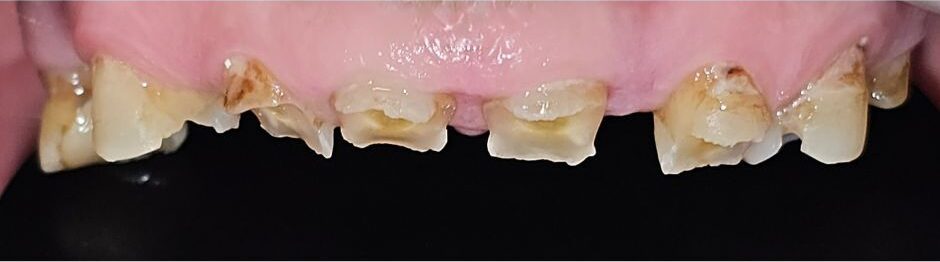 Gydytojos odontologės ortopedės Rūtos Krušinskaitės „All on 4” atvejis prieš