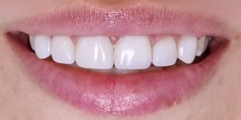 Gydytojos odontologės, estetinių restauracijų specialistės, Ingos Linkytės-Sližienės atvejis po