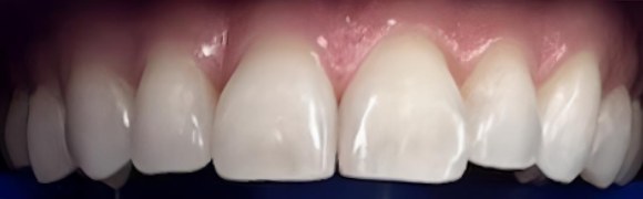 Burnos higienistės Kotrynos Daukšienės dantų balinimo Philips ZOOM sistema atvejis prieš