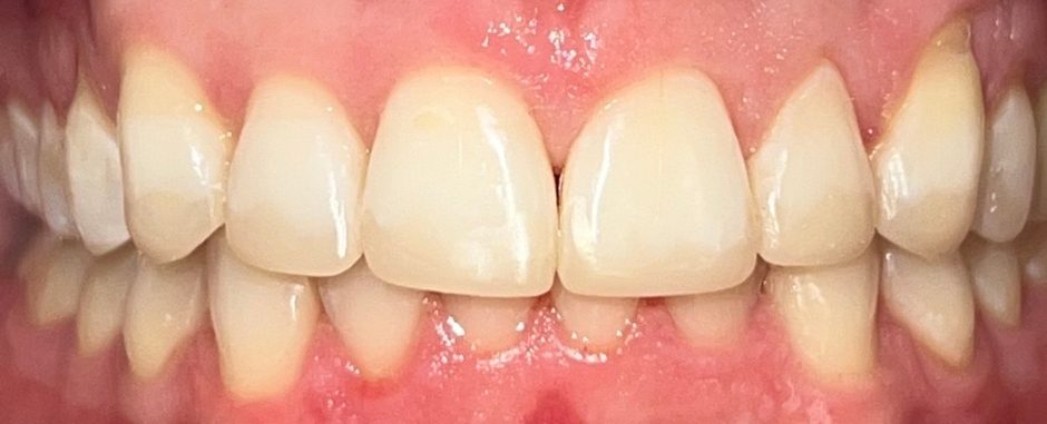 Dantų tiesinimo kapomis specialistės, gydytojos odontologės Viktorijos Šimkutės atvejis po