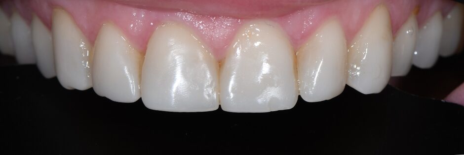 Gydytojo odontologo, estetinių restauracijų specialisto, Žilvino Budrevičiaus atvejis prieš