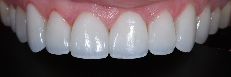 Gydytojo odontologo, estetinių restauracijų specialisto, Žilvino Budrevičiaus atvejis po