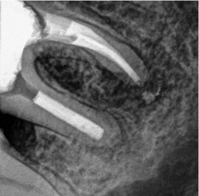 Gydytojos odontologės Veronikos Gražulytės dantų šaknų kanalų pergydymo atvejis prieš