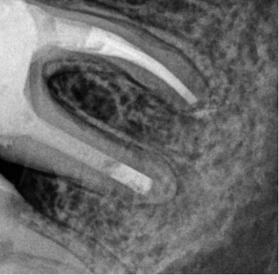 Gydytojos odontologės Veronikos Gražulytės dantų šaknų kanalų pergydymo atvejis po