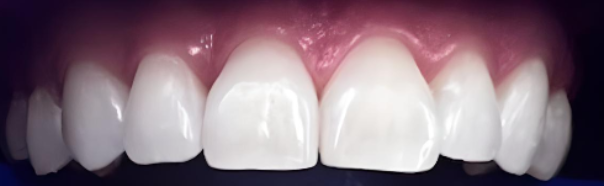 Burnos higienistės Kotrynos Daukšienės dantų balinimo Philips ZOOM sistema atvejis po