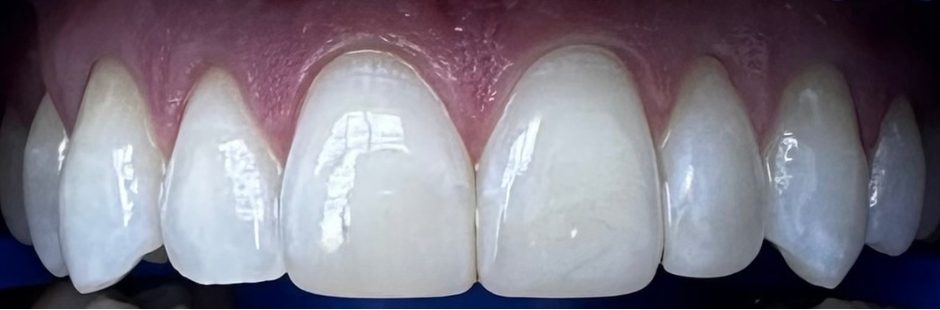 Burnos higienistės Radvilės Maksimavičiūtės dantų balinimo Philips ZOOM sistema atvejis po