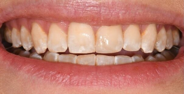 Gydytojo odontologo, estetinių restauracijų specialisto, Žilvino Budrevičiaus atvejis prieš