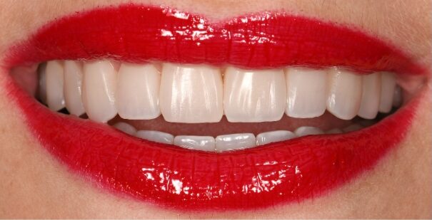 Gydytojo odontologo, estetinių restauracijų specialisto, Žilvino Budrevičiaus atvejis po