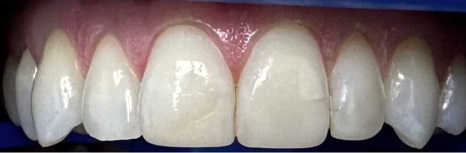 Burnos higienistės Radvilės Maksimavičiūtės dantų balinimo Philips ZOOM sistema atvejis prieš