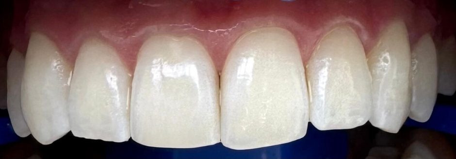 Burnos higienistės Radvilės Maksimavičiūtės dantų balinimo Philips ZOOM sistema atvejis po