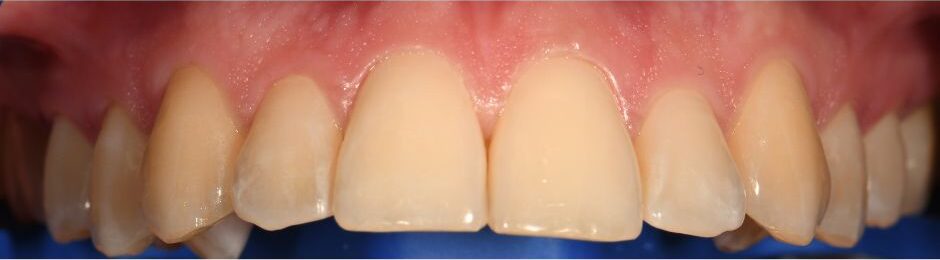 Burnos higienistės Žibuoklės Buinevičiūtės dantų balinimo Philips ZOOM sistema atvejis prieš