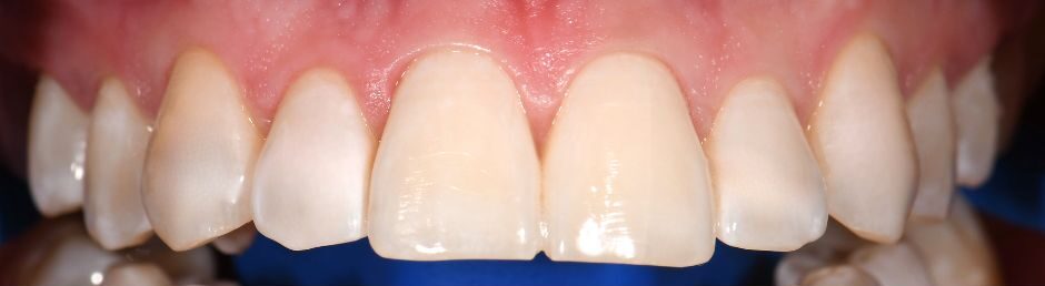 Burnos higienistės Žibuoklės Buinevičiūtės dantų balinimo Philips ZOOM sistema atvejis po